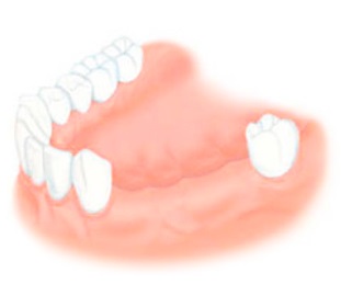 Частичная адентия зубов
