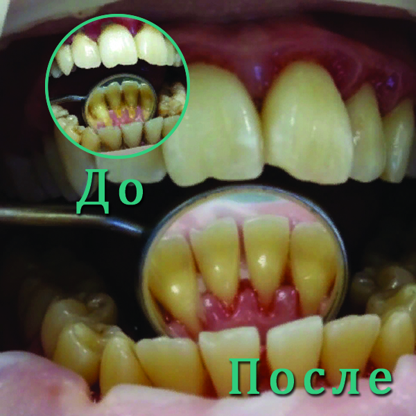 Удаление наддесневого и поддесневого зубного камня с язычной поверхности