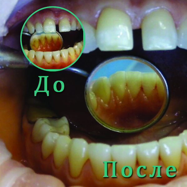 Удаление пигментированного зубного налета и наддесневого зубного камня с язычной поверхности